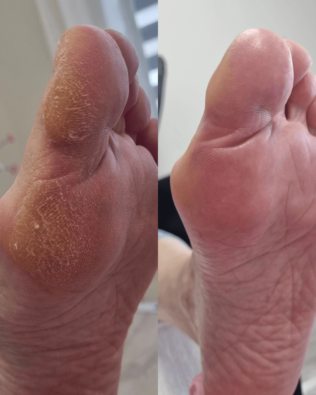 KART pedikúra - šetrné ošetření problematické pokožky